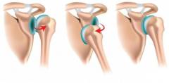 повторный вывих плеча