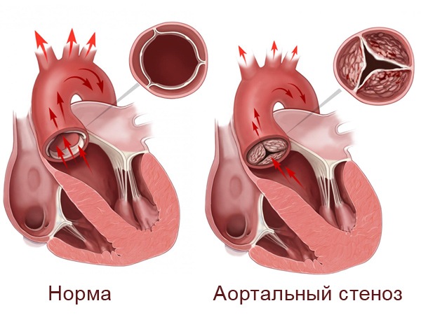 Врожденный порок сердца сужение аорты