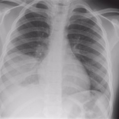 Описание рентгена легких при пневмонии