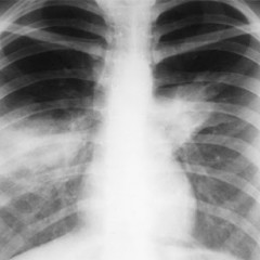 Описание рентгенограммы при пневмонии пример