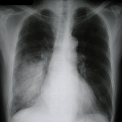 Рентген пневмонии и здоровых легких