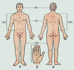 как определить площадь поражения при ожогах