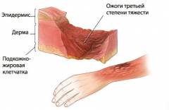 как определить площадь поражения при ожогах