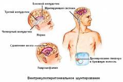 высокое внутричерепное давление у взрослых что делать. Смотреть фото высокое внутричерепное давление у взрослых что делать. Смотреть картинку высокое внутричерепное давление у взрослых что делать. Картинка про высокое внутричерепное давление у взрослых что делать. Фото высокое внутричерепное давление у взрослых что делать