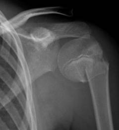 Какие последствия при переломе плечевой кости