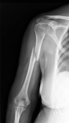 Перелом средней плечевой кости