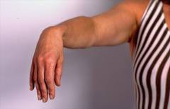 Перелом плечевой кости симптомы