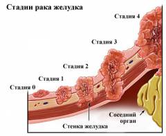 Полипы в желудке диета какие продукты противопоказаны