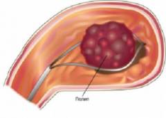 Полипы в желудке диета какие продукты противопоказаны