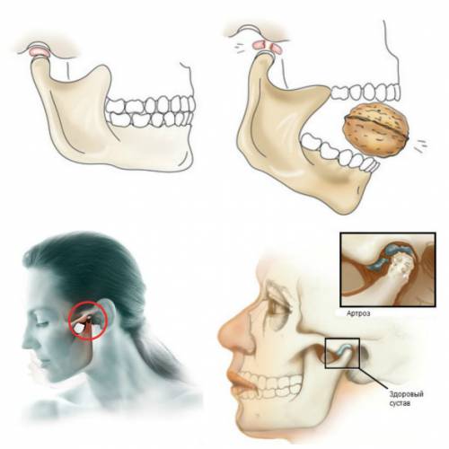При открытии рта болит ухо. Ревматоидный артрит ВНЧС. Вывих височно-нижнечелюстного сочленения (вывих нижней челюсти).