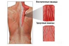 Миалгия что это за болезнь симптомы и причины лечение. Смотреть фото Миалгия что это за болезнь симптомы и причины лечение. Смотреть картинку Миалгия что это за болезнь симптомы и причины лечение. Картинка про Миалгия что это за болезнь симптомы и причины лечение. Фото Миалгия что это за болезнь симптомы и причины лечение