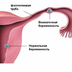 Что находится справа внизу живота у женщины и почему болит