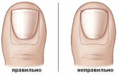 Неправильно подстригли ногти воспаление