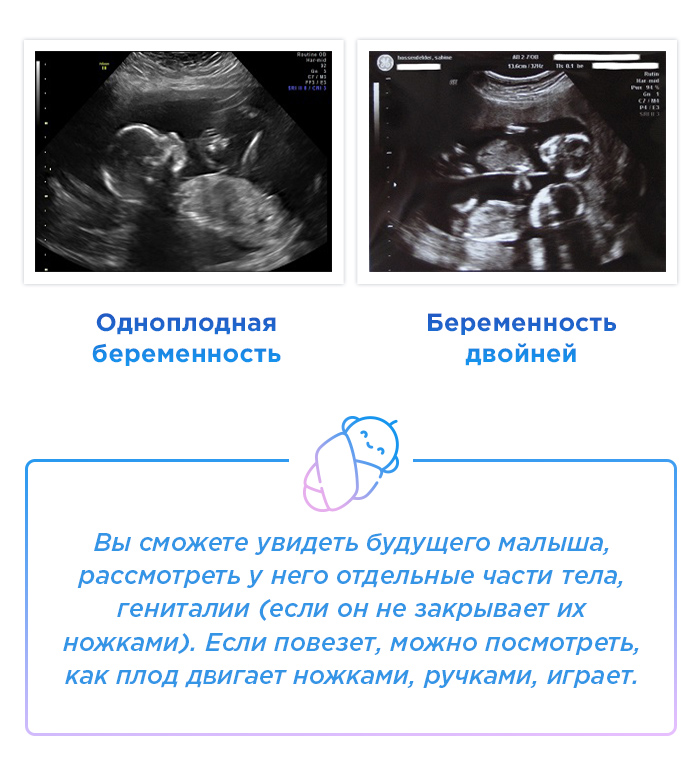 18 недель ощущение. УЗИ 17 недель беременности двойня. УЗИ двойни на 18 неделе беременности. 17 Неделя беременности шевеление плода двойня. 18 Недель беременности размер плода.