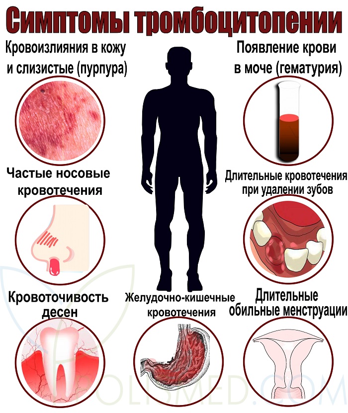 симптомы тромбоцитопении