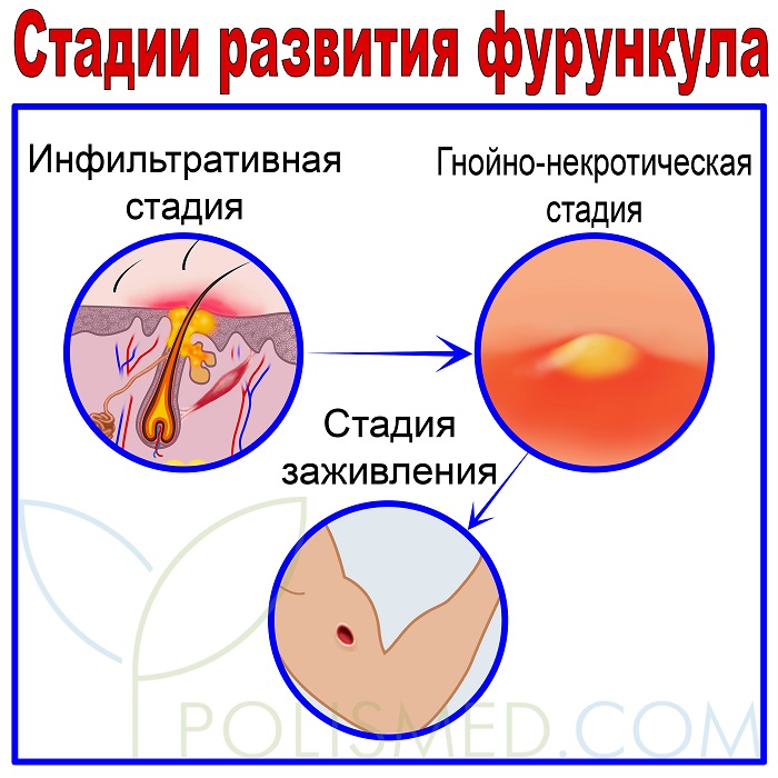 Как начинается чирей фото начальной стадии Фурункул - причины, симптомы, стадии и методы лечения. Фурункул на лице, в паху,