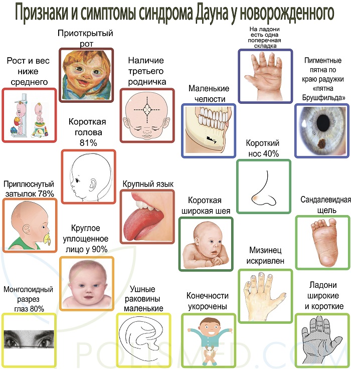 Клинические признаки синдрома дауна. Синдром Дауна внешние признаки. Характерные признаки проявления болезни синдрома Дауна. Симптомы синдрома Дауна у новорожденных. Синдром Дауна симптомы у новорожденного.