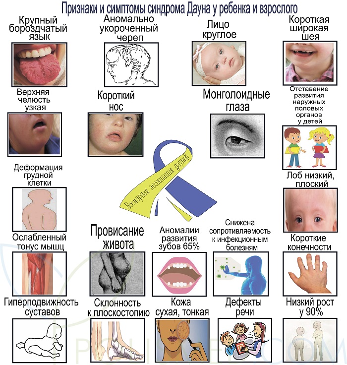 Клиническая картина синдрома дауна