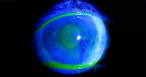 Синдром сухого глаза и выделения из глаз