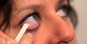 Синдром сухого глаза и выделения из глаз