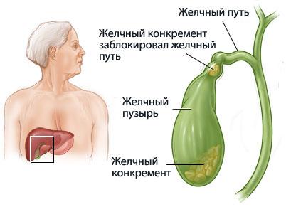 Колит кишечника в правом боку лечение