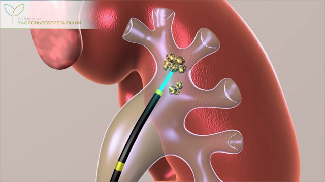 Дробление камня в почке
