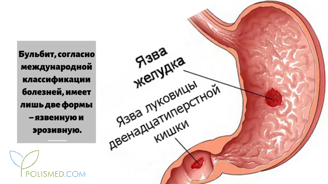 Де нол при бульбите схема