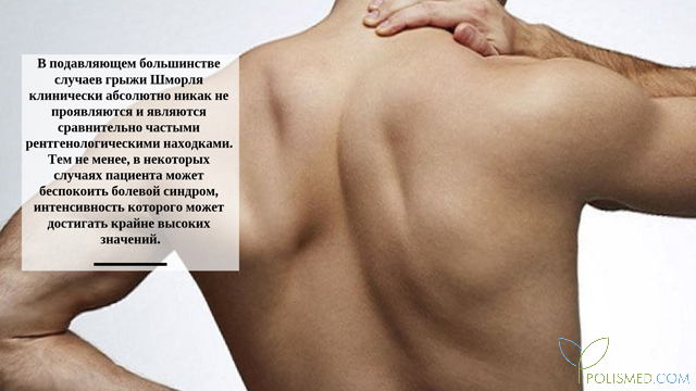 Симптомы грыжи Шморля