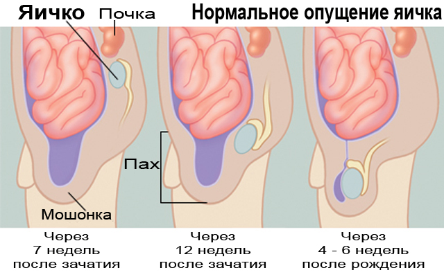 Крипторхизм