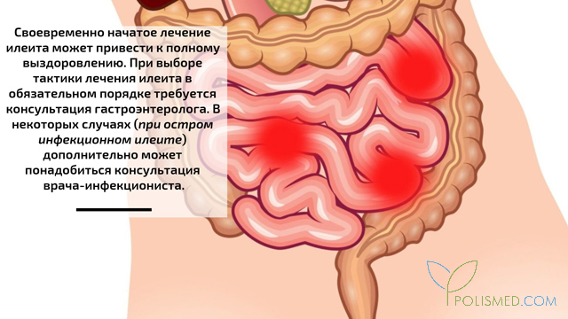 Где находится подвздошная кишка и как болит