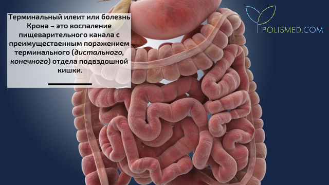 Где находится подвздошная кишка и как болит