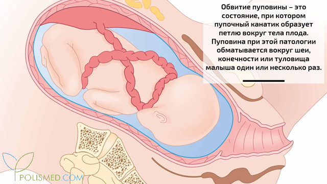 Обвитие пуповины