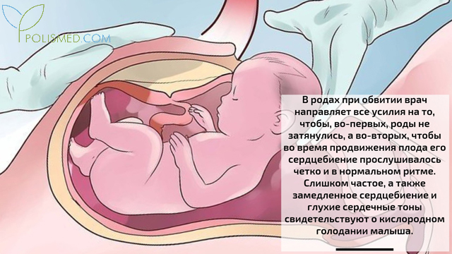 Роды при обвитии пуповины