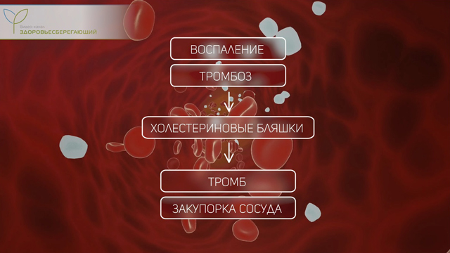 Образование тромбов, воспаление в сосудах и атеросклероз