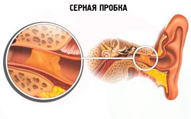 Серная пробка - причины, симптомы, диагностика и лечение